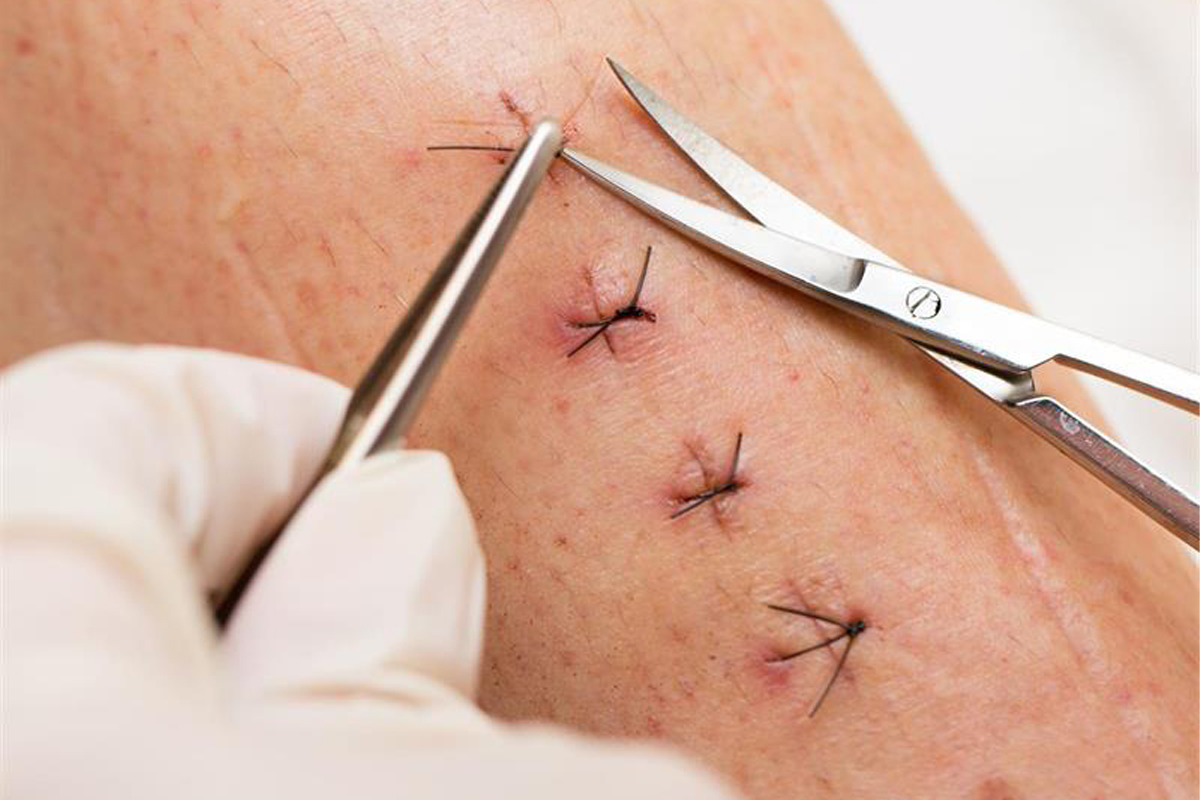 SUTURING AND REMOVAL OF SUTURES